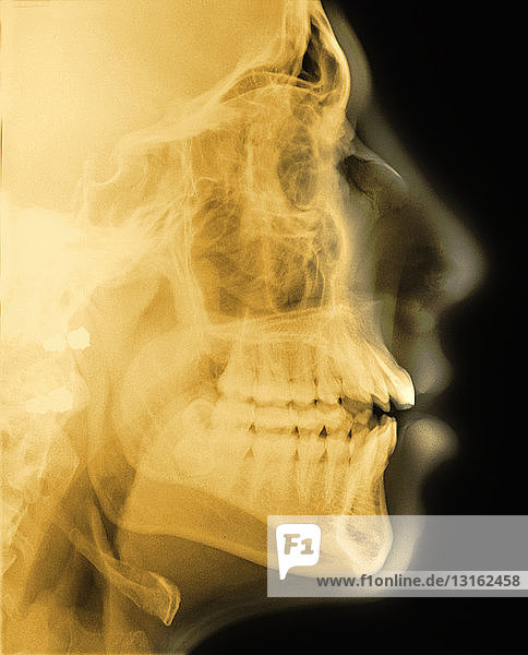 Röntgenaufnahme des Kopfes im Profil