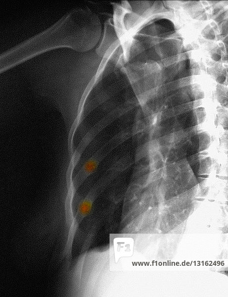 Röntgenaufnahme der Brust mit verheilten Rippenfrakturen