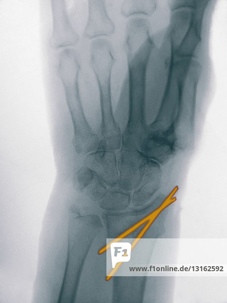 Röntgenbild einer mit Stiften stabilisierten Radiusfraktur