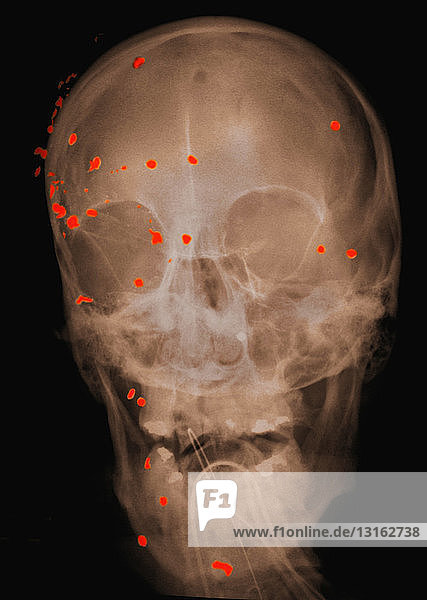 Schädel-Röntgenbild mit Schussverletzungen
