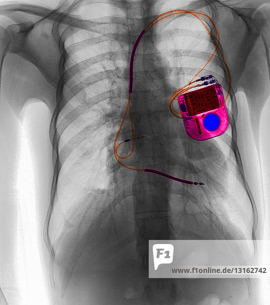 Brust-Röntgenbild zeigt Herzschrittmacher