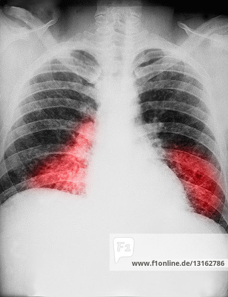 chest x-ray of histoplasmosis fungal infection