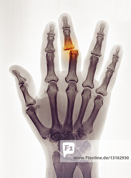 hand x-ray showing a dislocation