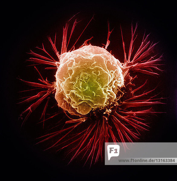 Rasterelektronenmikroskopische Aufnahme  Brustkrebszelle