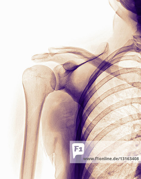 normal shoulder x-ray of a 35 year old woman