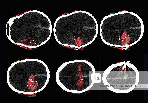 CT-Untersuchung des Gehirns eines Mannes  der sich erschossen hat