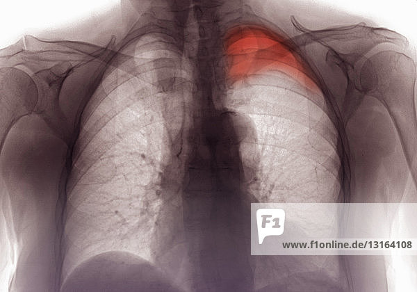 Röntgenbild mit Rippenfraktur und Pneumothorax