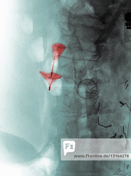 X-ray showing Greenfield umbrella