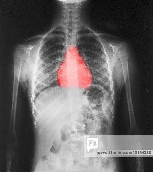 Normales Brust-Röntgenbild eines 7-jährigen Mädchens