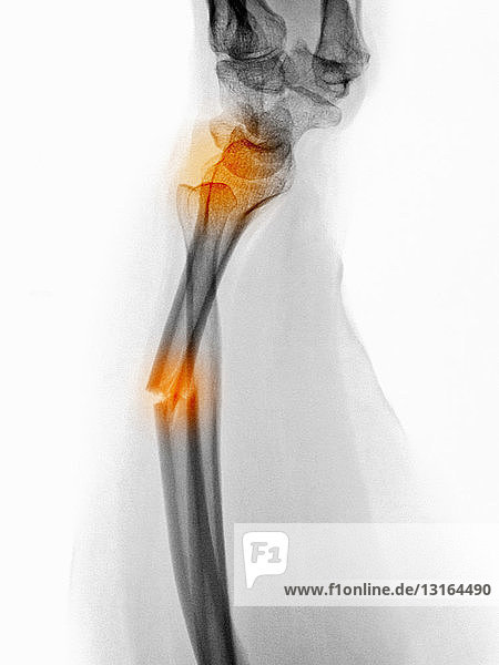 Röntgenbild einer Radius-Unterarmfraktur