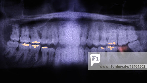 Panorex of teeth showing cavities