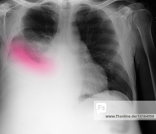 Chest X-ray showing pleural effusion