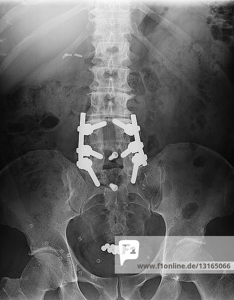 X-ray showing spinal fusion and objects in bladder