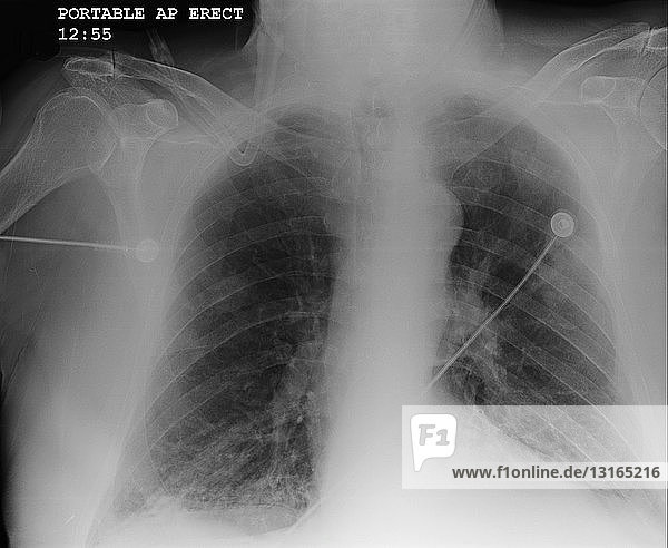 Röntgenaufnahme der Brust mit COPD