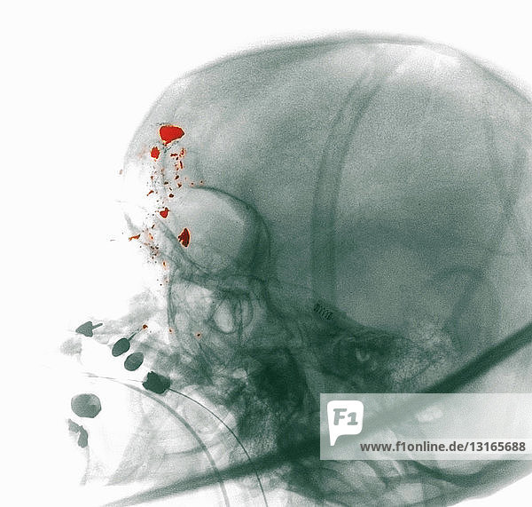 Röntgenbild  das eine Schusswunde am Kopf zeigt