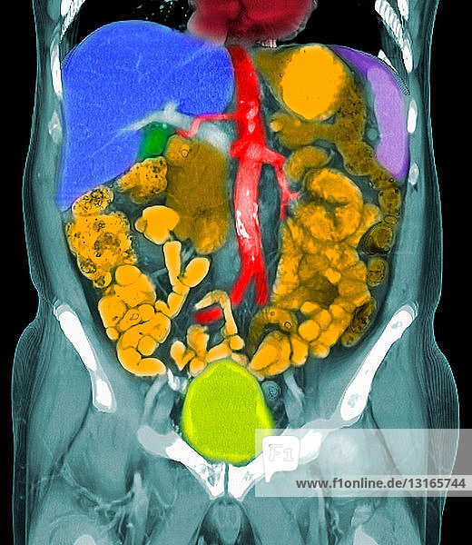 CT-Untersuchung von Metastasen bei Prostatakrebs