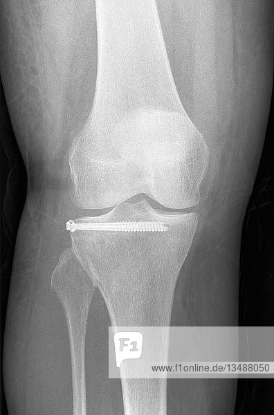 X-ray of a patient after tibial plateau fracture with 2 screws