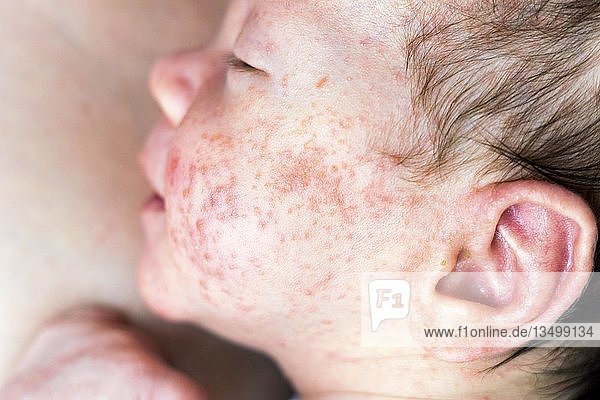 Newborn baby with many red spots caused by neurodermatitis  Poland  Europe