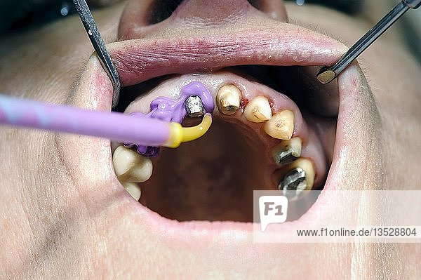 Masse  die für den Korrekturabdruck während der Zahnbehandlung verwendet wird