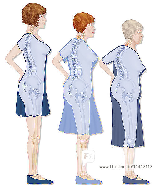 Illustration of the evolution of osetoporosis shown in the outline of a woman. On the left  a young woman with an upright posture. In the middle  a 60-year old woman suffering from medium osteoporosis. She has lost several centimeters in height and is becoming stooped. On the right  a 70-year old woman with severe osteoporosis. She has pronounced compression of the vertebra and her pelvis is tilting forwards.
