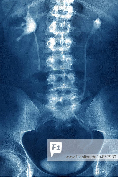 Renal colic of the right kidney blockage in the urethra by a nephrolith with upstream renal dilation. Frontal abdominal x-ray.