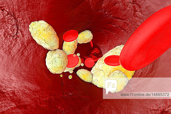 3D gerenderte Illustration  Visualisierung von Fett  das eine Arterie verstopft und die Krankheitsarteriosklerose bildet