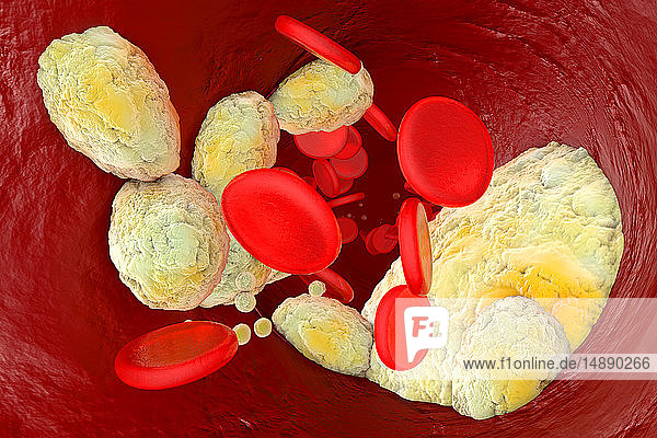 3D-gerenderte Illustration  Visualisierung von Fett  das eine Arterie verstopft und die Krankheit Arteriosklerose verursacht