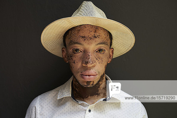 Porträt eines jungen Mannes mit Vitiligo  der einen Hut trägt