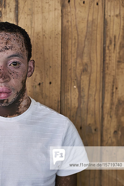 Halbporträt eines jungen Mannes mit Vitiligo vor einer Holzwand