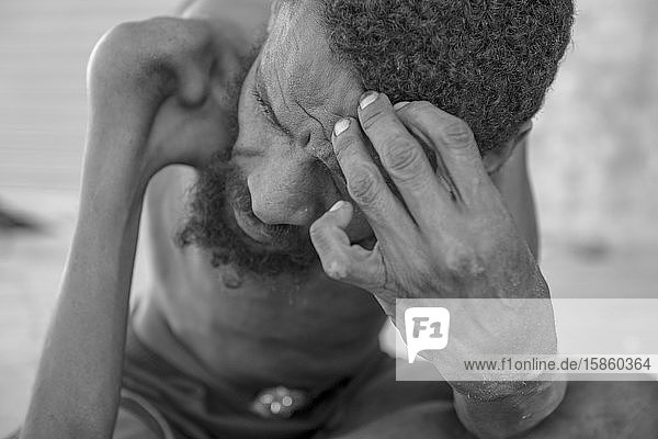 Porträt eines obdachlosen Mannes mit angeborener Krankheit in der Innenstadt von Recife
