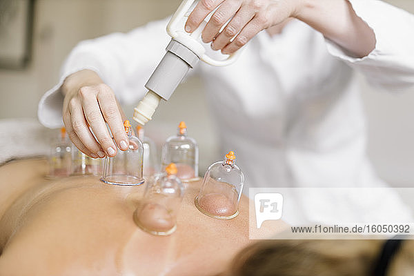 Cupping therapy  treatment at back