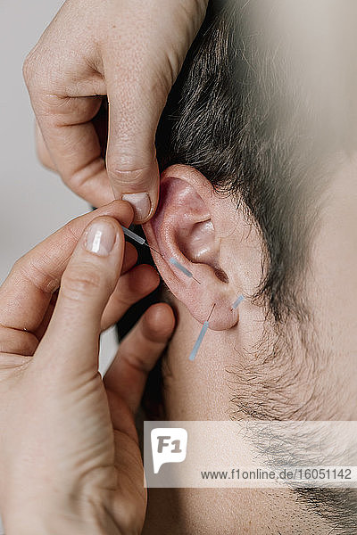 Traditionelle Chinesische Medizin  TCM  Akupunktur  Ohr mit Akupunkturnadel während der Behandlung