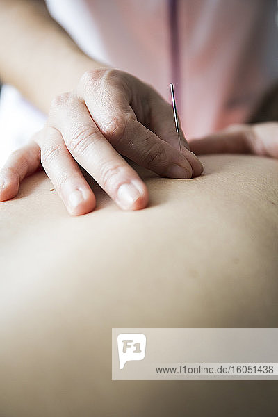 Nahaufnahme: Akupunkteurin setzt Akupunkturnadeln in den Rücken einer Frau