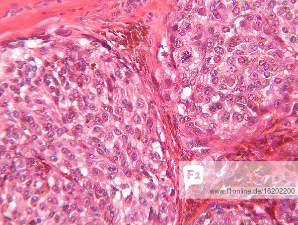 Mikroskopische Ansicht eines malignen Melanoms