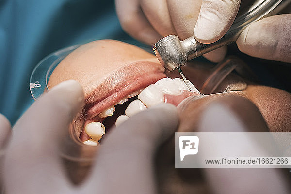 Mund einer Patientin während eines kieferorthopädischen Eingriffs