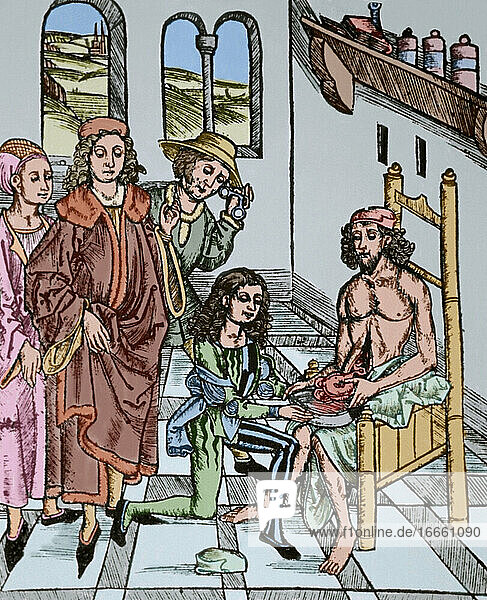 Geschichte der Medizin. Sättigung des Darms. Holzschnitt in Dies ist das Buch Der Chirurgia (15. Jahrhundert). Kolorierter Kupferstich.