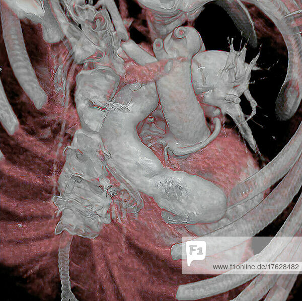 Complex congenital cardiopathy. The 3D CT scan allows three-dimensional visualization of the heart after surgery to treat a very complicated congenital cardiopathy.
