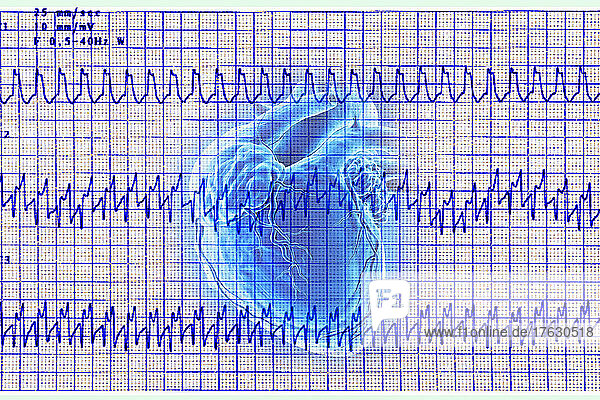 Atrial tachycardia electrocardiogram  heart rhythm disorder where the patient complains of rapid palpitation sensations.