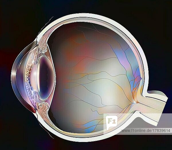Eye: clouding of the lens in case of anterior subcapsular cataract.
