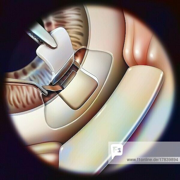 Eye (glaucoma): sclerectomy with removal of a small part of the trabeculum.