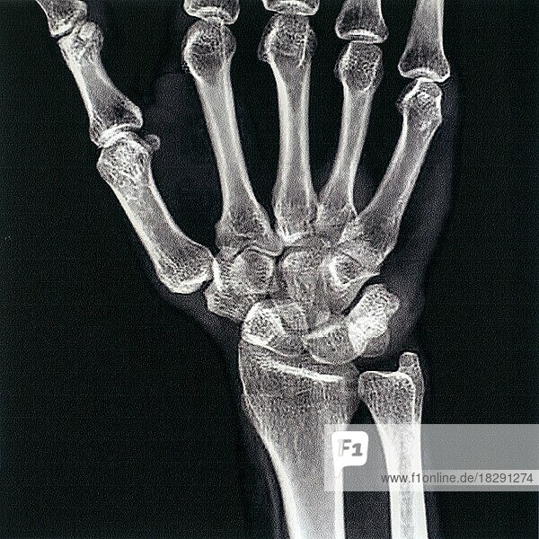 Röntgenaufnahme aus der Mitte des 20. Jahrhunderts  Röntgenbild des De-Quervain-Syndroms  einer mukoiden Degeneration zweier Sehnen  die die Bewegung des Daumens steuern