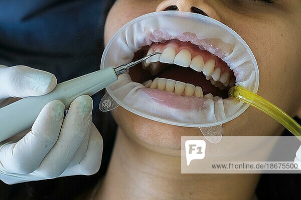 Nahaufnahme der hygienischen Reinigung der Zähne von Plaque. Die Hände des Zahnarztes reinigen die Zähne des Patienten von Plaque mit einem speziellen Gerät. Konzept der Zahnaufhellung  Zahnpflege  Mundgesundheit  Zahnmedizin Werbung