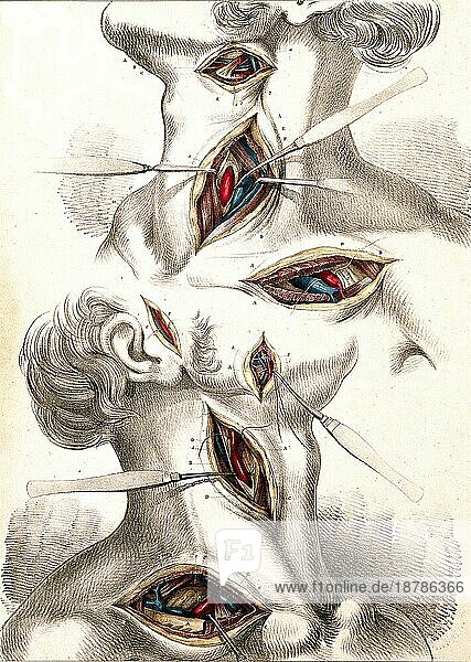 Medizin  Anatomie  Chirurgie der Arteria carotis und subclavia  zwei Abbildungen mit Schnitten in Kopf und Hals  mit chirurgischen Instrumenten  die die Arterien anzeigen  um 1834  Historisch  digital restaurierte Reproduktion von einer Vorlage aus dem 19. Jahrhundert
