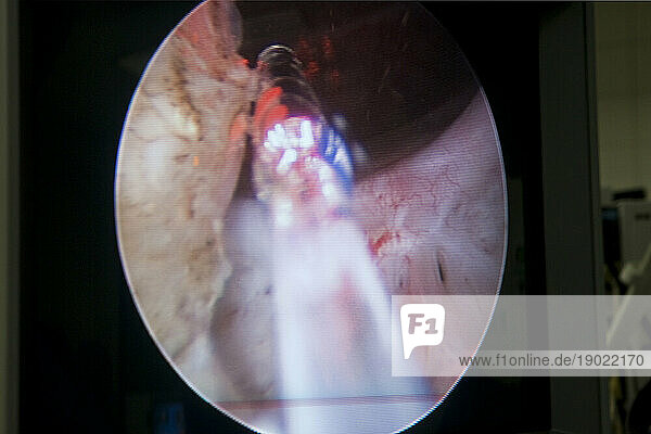 Laser surgery for treatment of benign prostatic hyperplasia  endoscopic image.