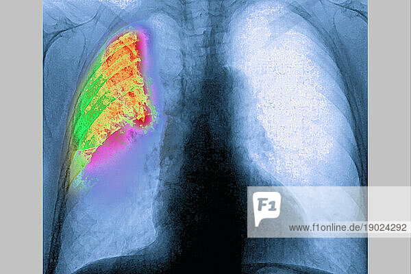 Pneumonia in a right lung (acute respiratory infection)  revealed by frontal chest X-ray.