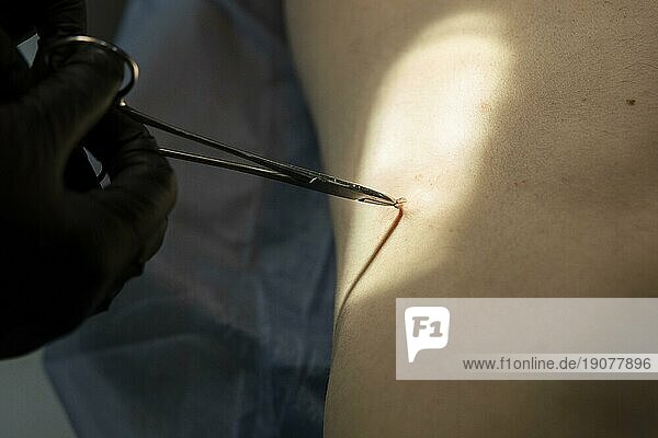 Arzt  der einen chirurgischen Eingriff zur Entfernung eines Leberflecks durchführt