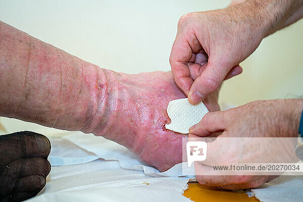 Care of a patient's foot ulcer. Wound cleaning and dressings.