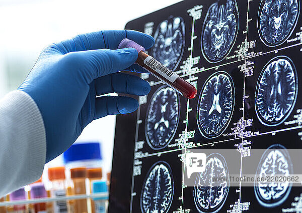 Neurology Research Patients blood sample being checked against the medical scan during a clinical trial