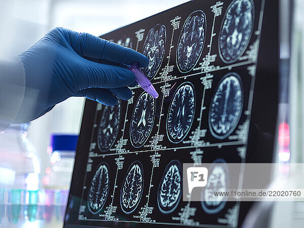 Dementia and Alzhiemer s Research  Scientist preparing human sample during a clinical trial